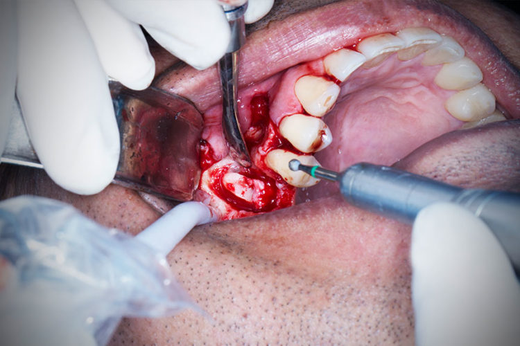 Dental-Implant-Seminar 2019
