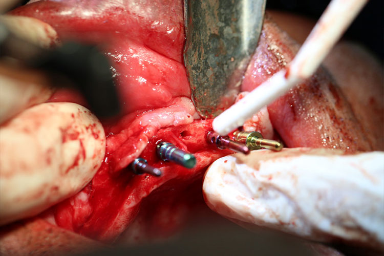 Dental Implant Training Live Patient Seminar