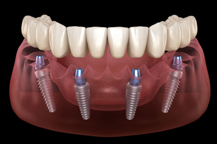 all on 4 -6 full arch dental implant training