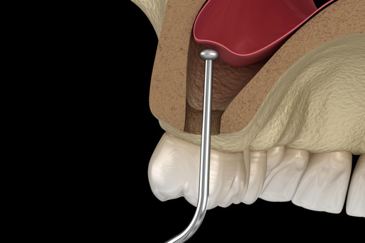 sinus lift dental implant training live patient program