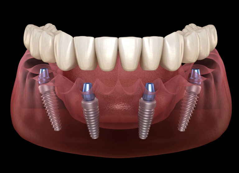 all on 4 -6 full arch dental implant training